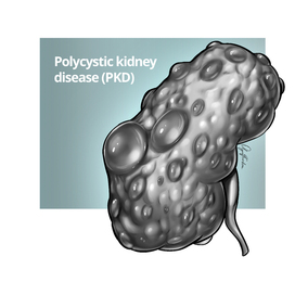 Chronic kidney disease