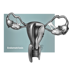 Endometriosis. Medical illustration.