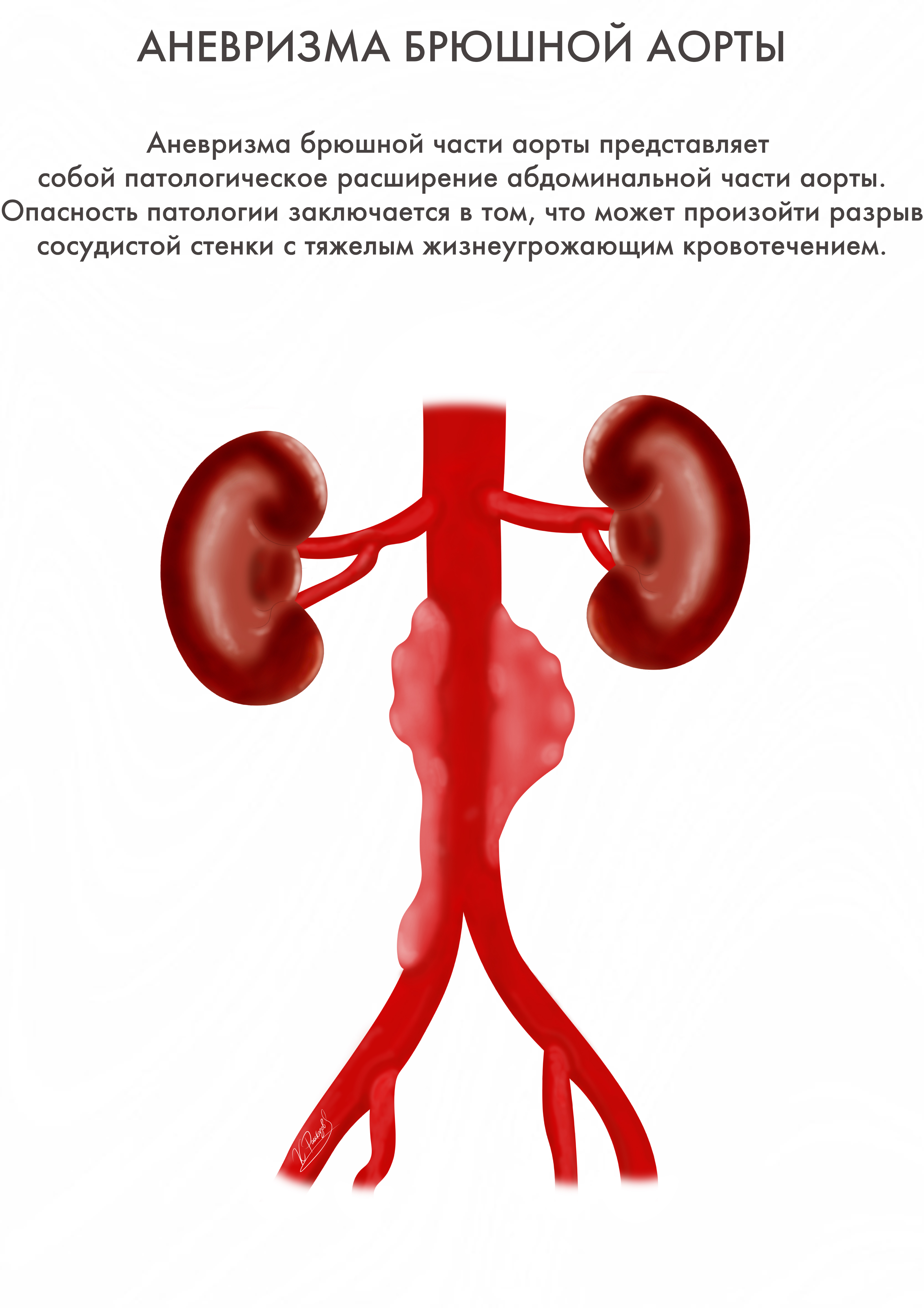 Аневризма брюшной аорты